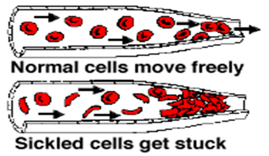 A graphic image depicting the difference between normal cells moving freely and how sickled cells get stuck