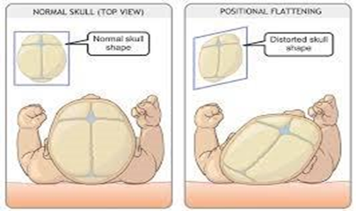 A image showing the difference between a normal skull and one with positional flattening