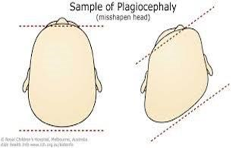 A image showing the difference between a normal skull and one with positional flattening
