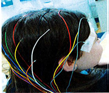 Photograph of electrodes attached to patients scalp.