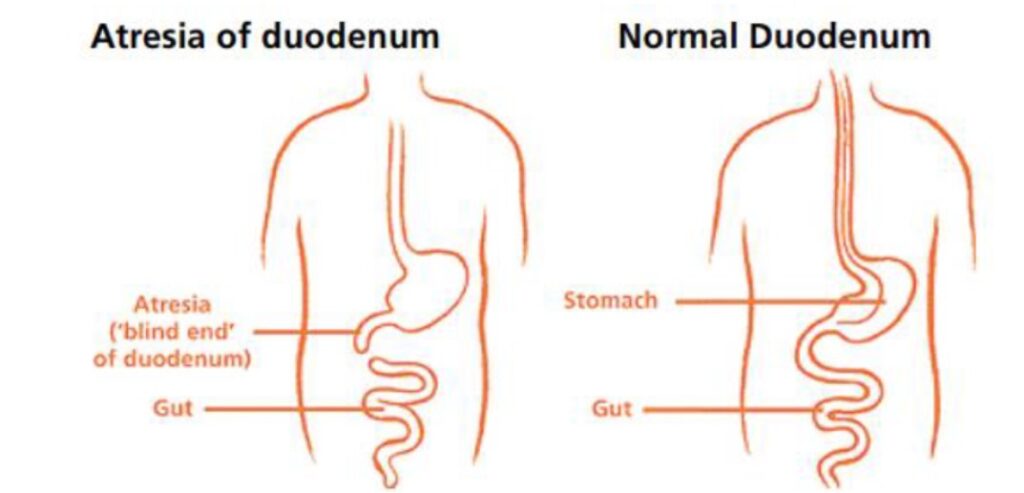 Diagram of atresia of duodenum and normal duodenum