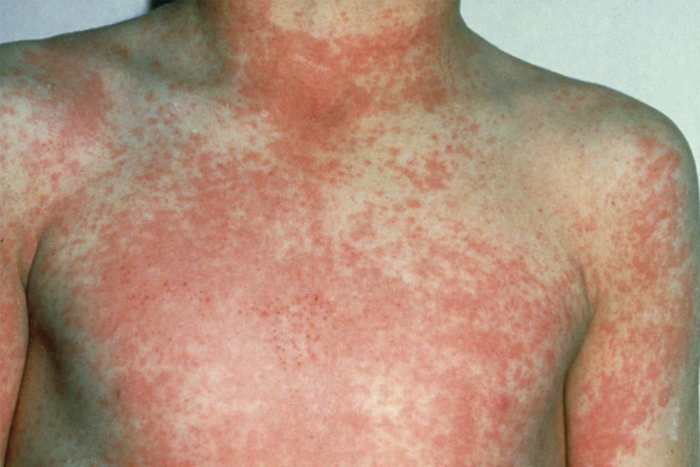 How to spot the symptoms of scarlet fever in your child