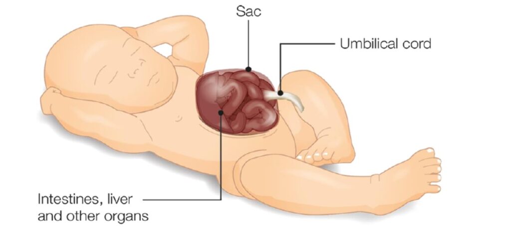 Image of a baby with Sac, Umbilical cord, and other organs including intestines and liver labelled.