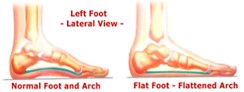 Illustration showing normal foot arch and flat foot arch