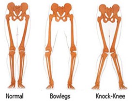 Illustration showing normal legs, bow legs and knock knees