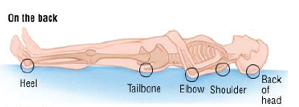 an example of where pressure ulcers can occur when lying on back