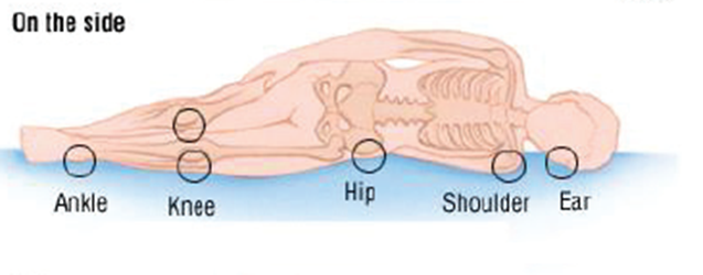 an example of where pressure ulcers can occur when lying on side