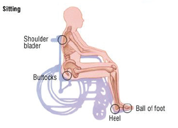 an example of where pressure ulcers can occur when sitting in a wheelchair