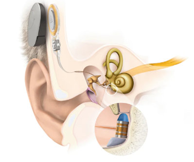 Diagram Vibrant Soundbridge middle ear implant. Image courtesy of Medel, 2022