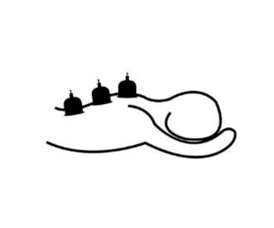 An image depicting someone having cupping therapy on their back.