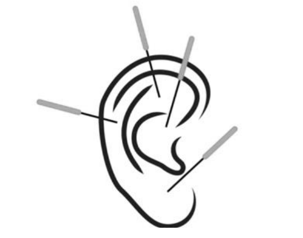 An ear with needles sticking out, depicting an ear acupuncture.