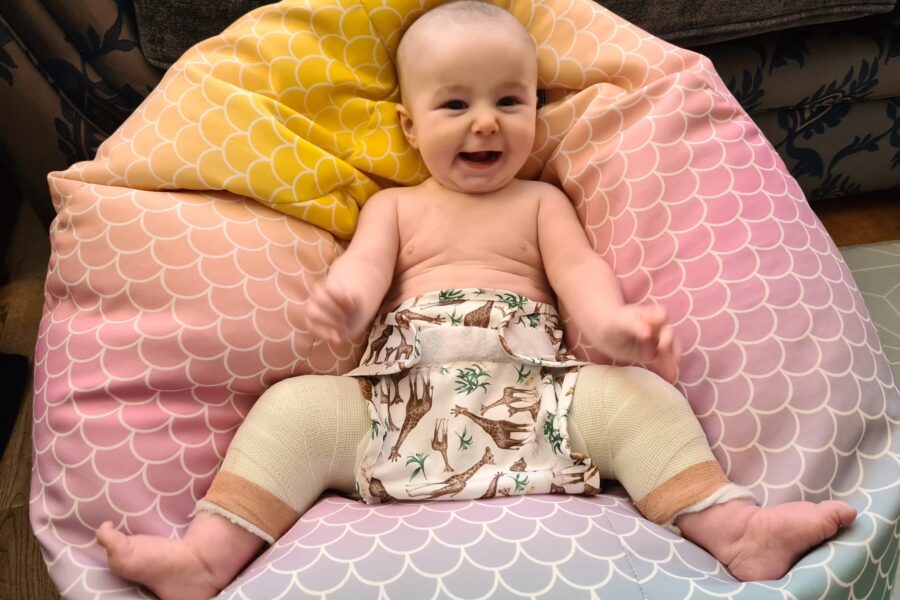 baby in hip brace